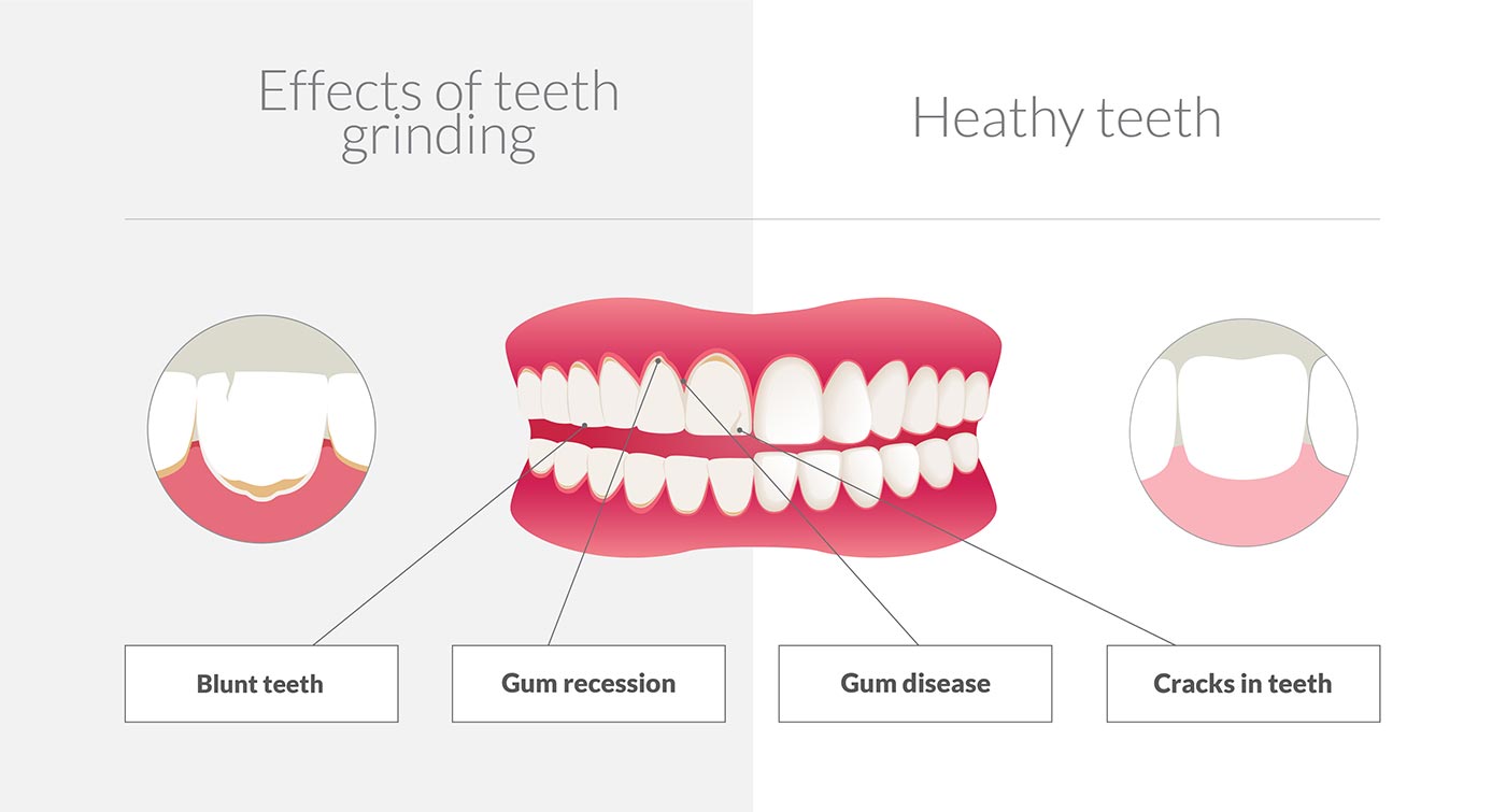 Teeth Grinding Dentist Neutral Bay Shore Dental