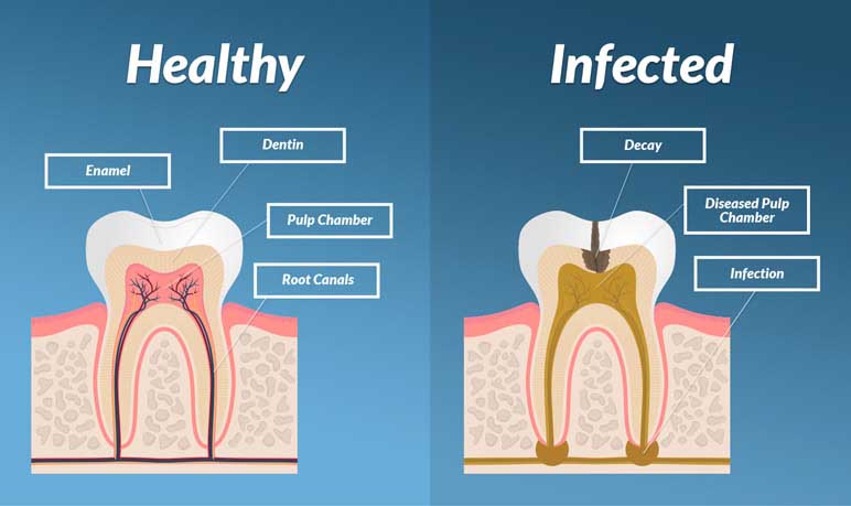 difference between a healthy tooth and a tooth with infected root canal