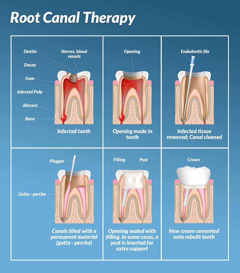 what happens in a root canal treatment?